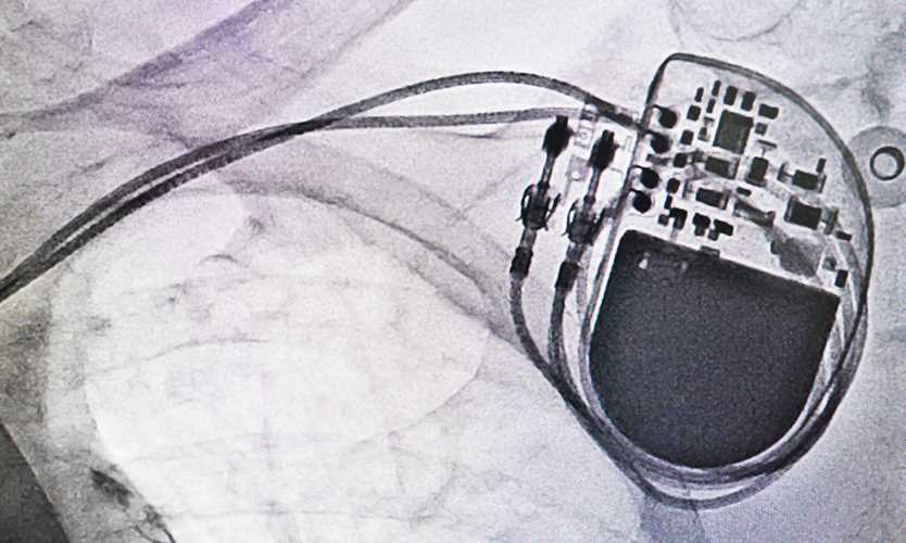 Pacemaker